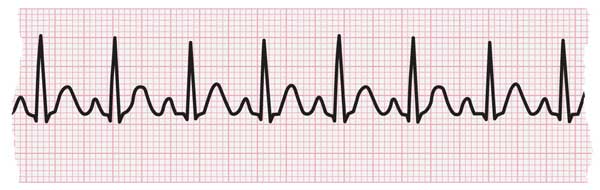 ECG strip showing tachycardia