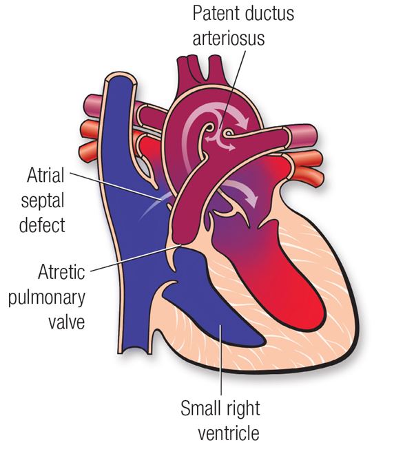 Pulmonary atresia diagram