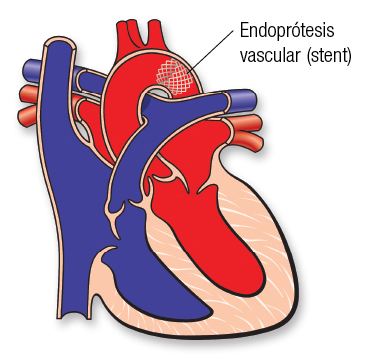 CoA Stent SP