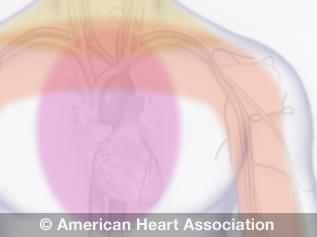 angina illustration