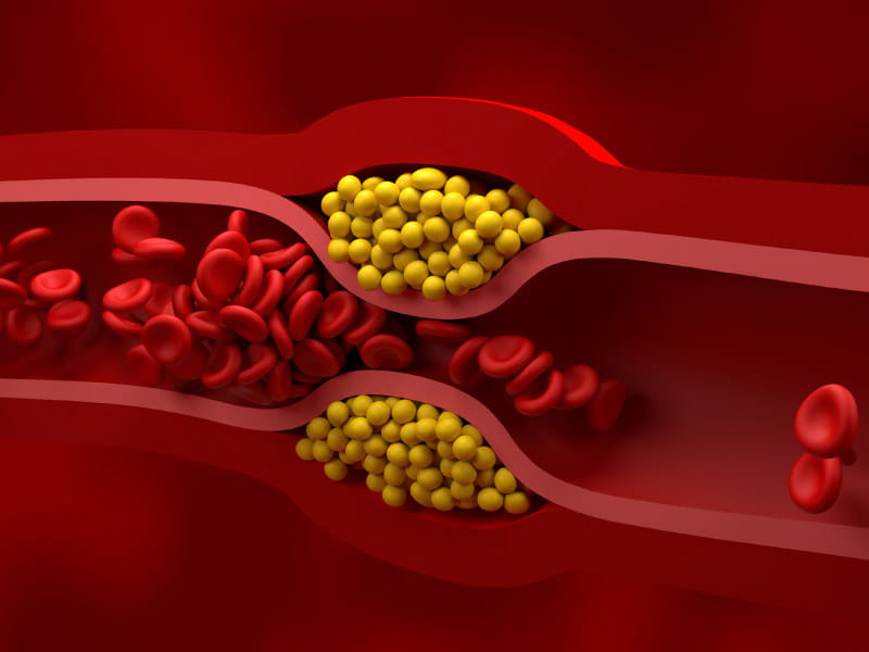 Low-density lipoprotein (LDL), or 