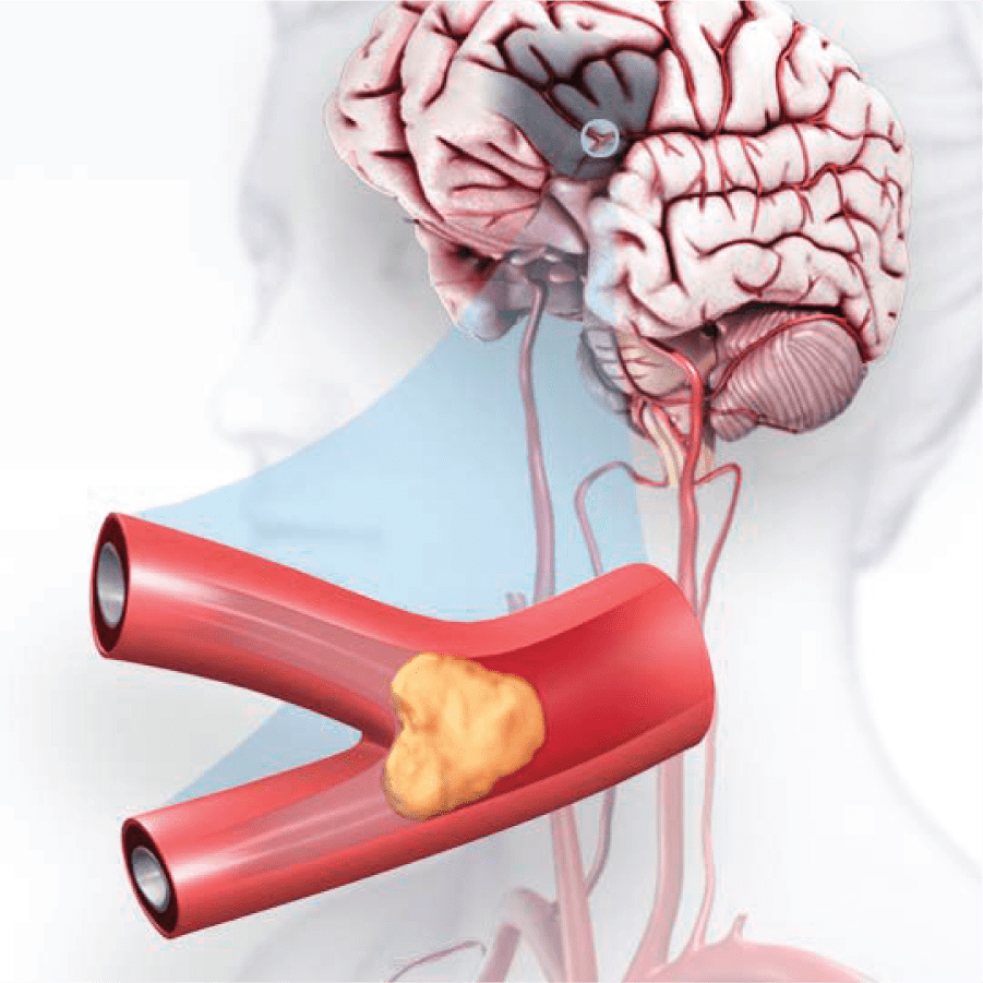 Illustration of a stroke