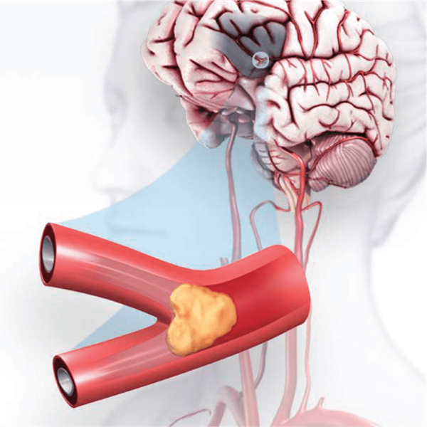 Ilustración de un ataque o derrame cerebral