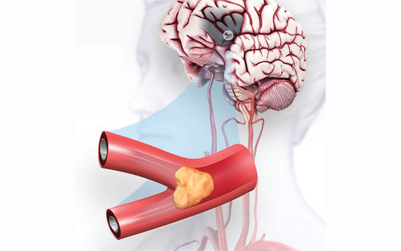 Ischemic Stroke - Smartphone and Narrowed Arteries - Vascular - diseases - ischemia - dr - qaisar - ahmed - dixe - cosmetics