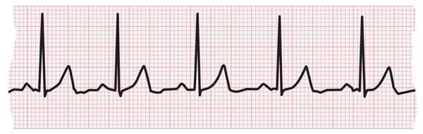 tachycardia-fast-heart-rate-american-stroke-association