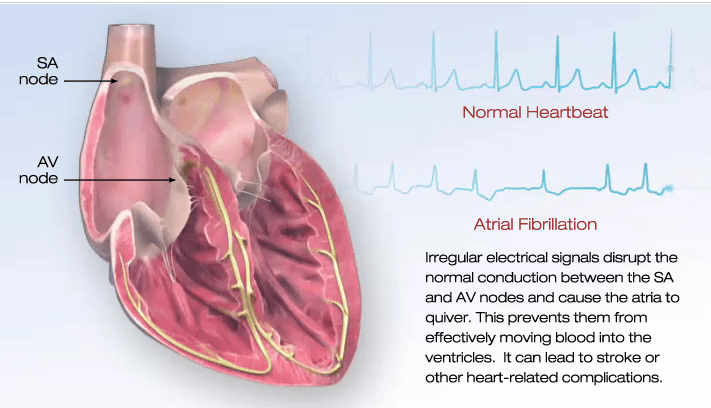 they-re-investing-in-research-to-treat-irregular-heartbeats-like-their