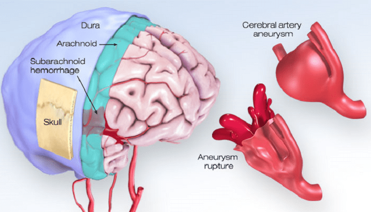 What is an Arteriovenous Malformation | American Stroke Association