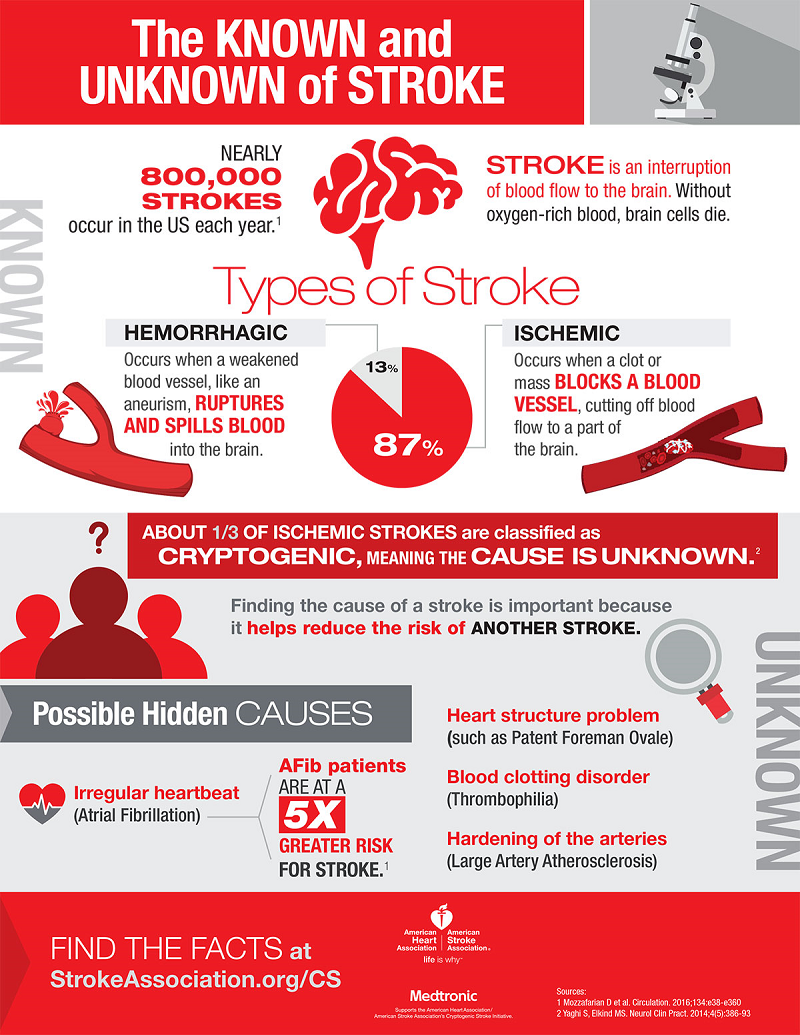 Infographic Stroke Types